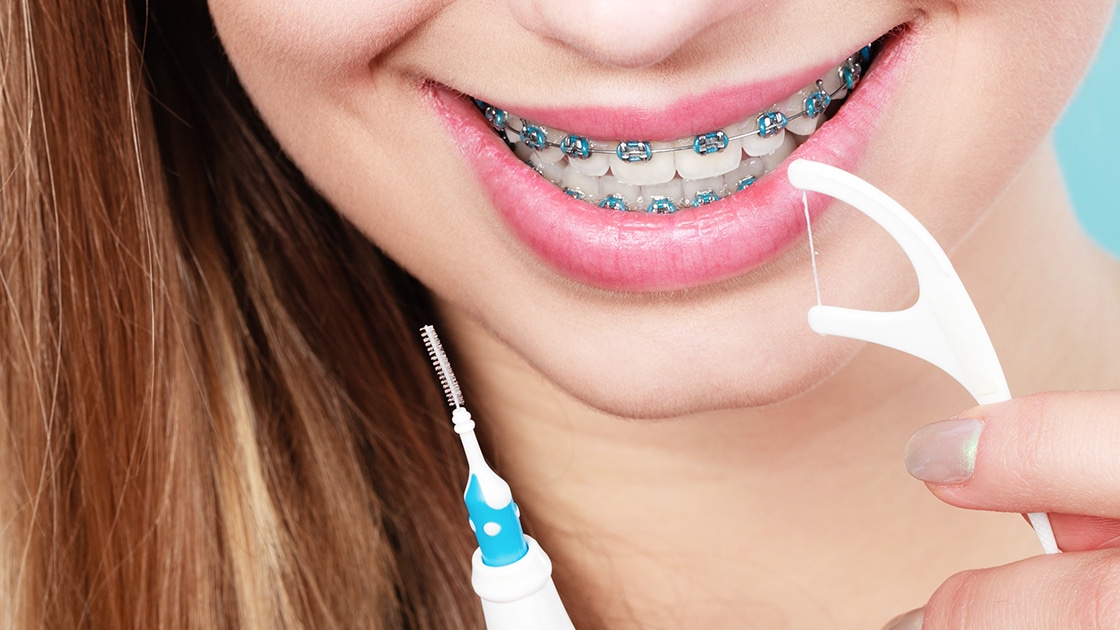 Braces Care= Photo